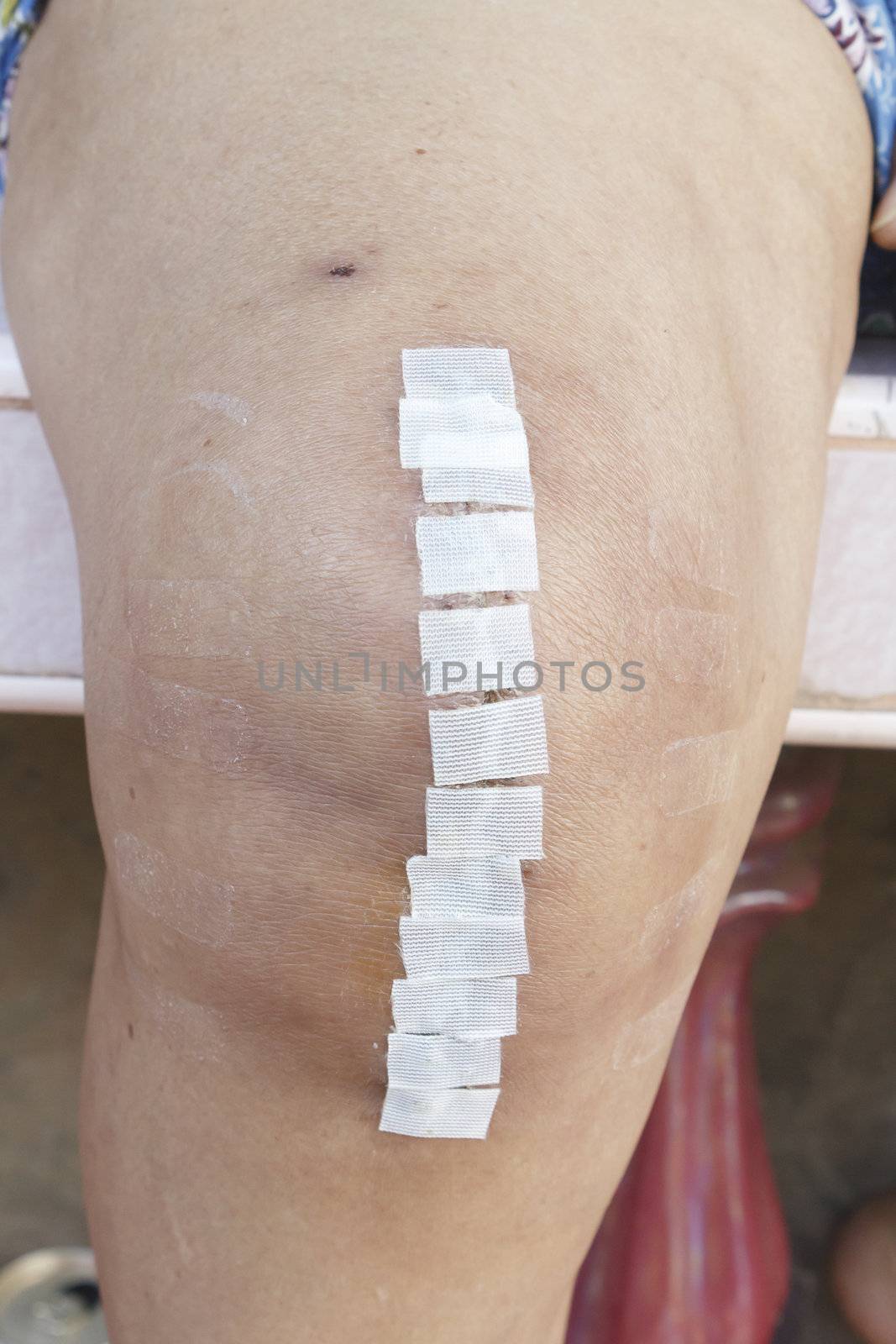 Knee replacement incision by olovedog