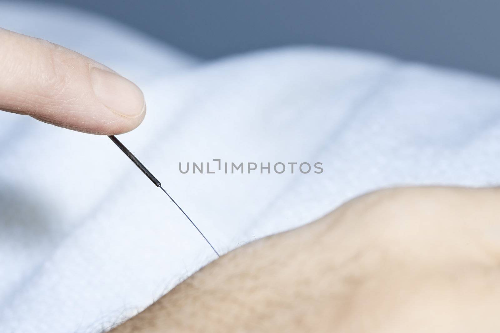 Acupuncture needle in skin by elenathewise