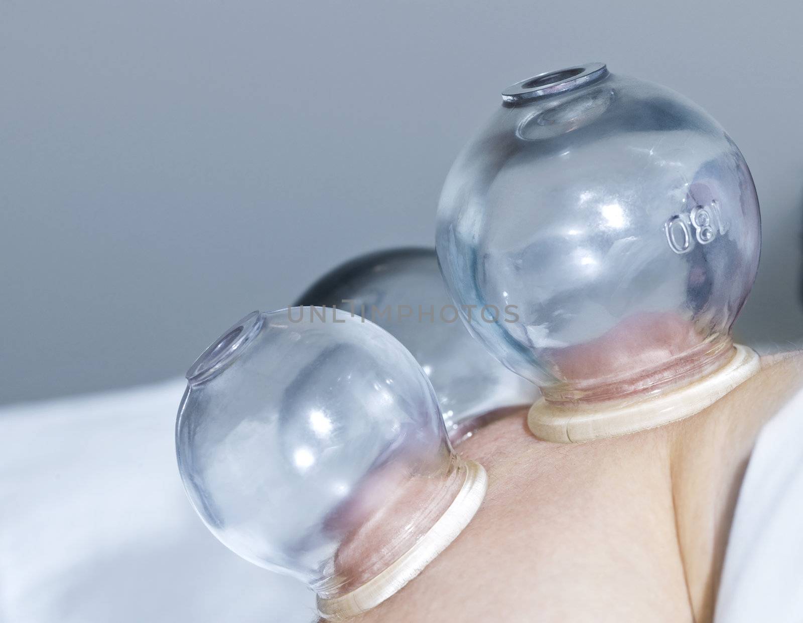 Applying cupping therapy in traditional chinese medicine on man's shoulder