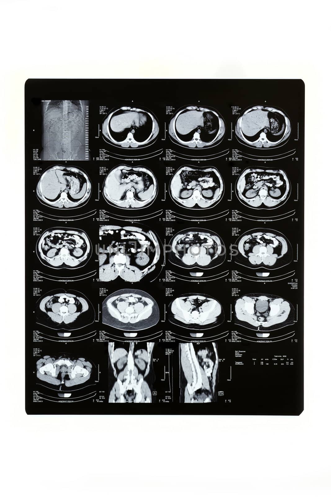 Computed tomography (CT) of the abdomen