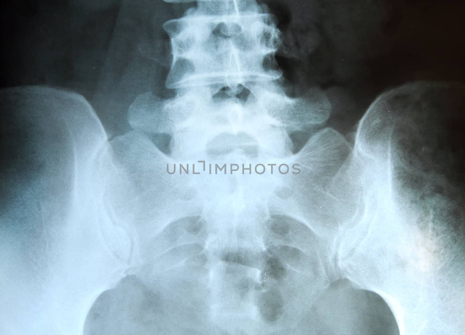 X-ray of the pelvis and spinal column. 