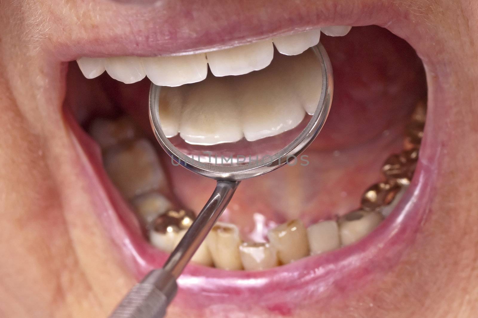 teeth examination by Jochen
