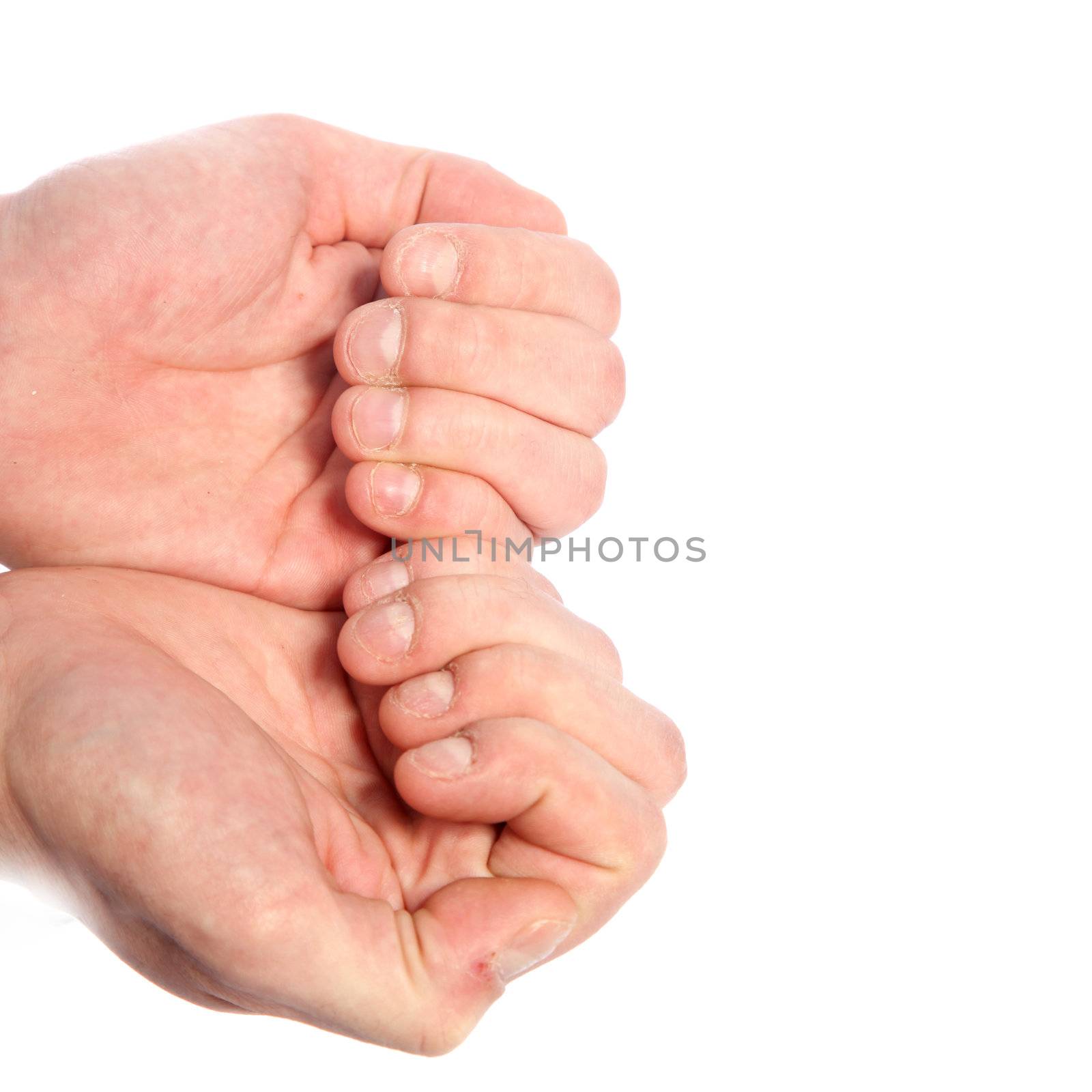 Fingers and nails of a nail biter. Isolated on white