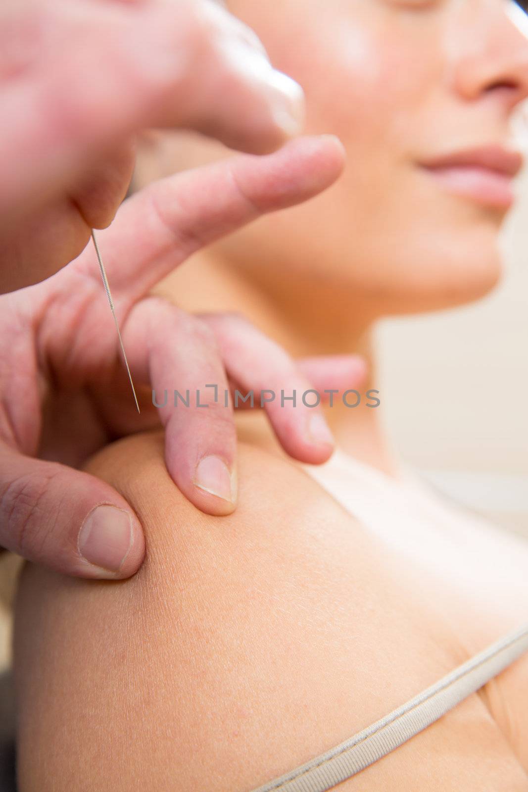 Doctor hands acupuncture needle pricking on woman patient closeup