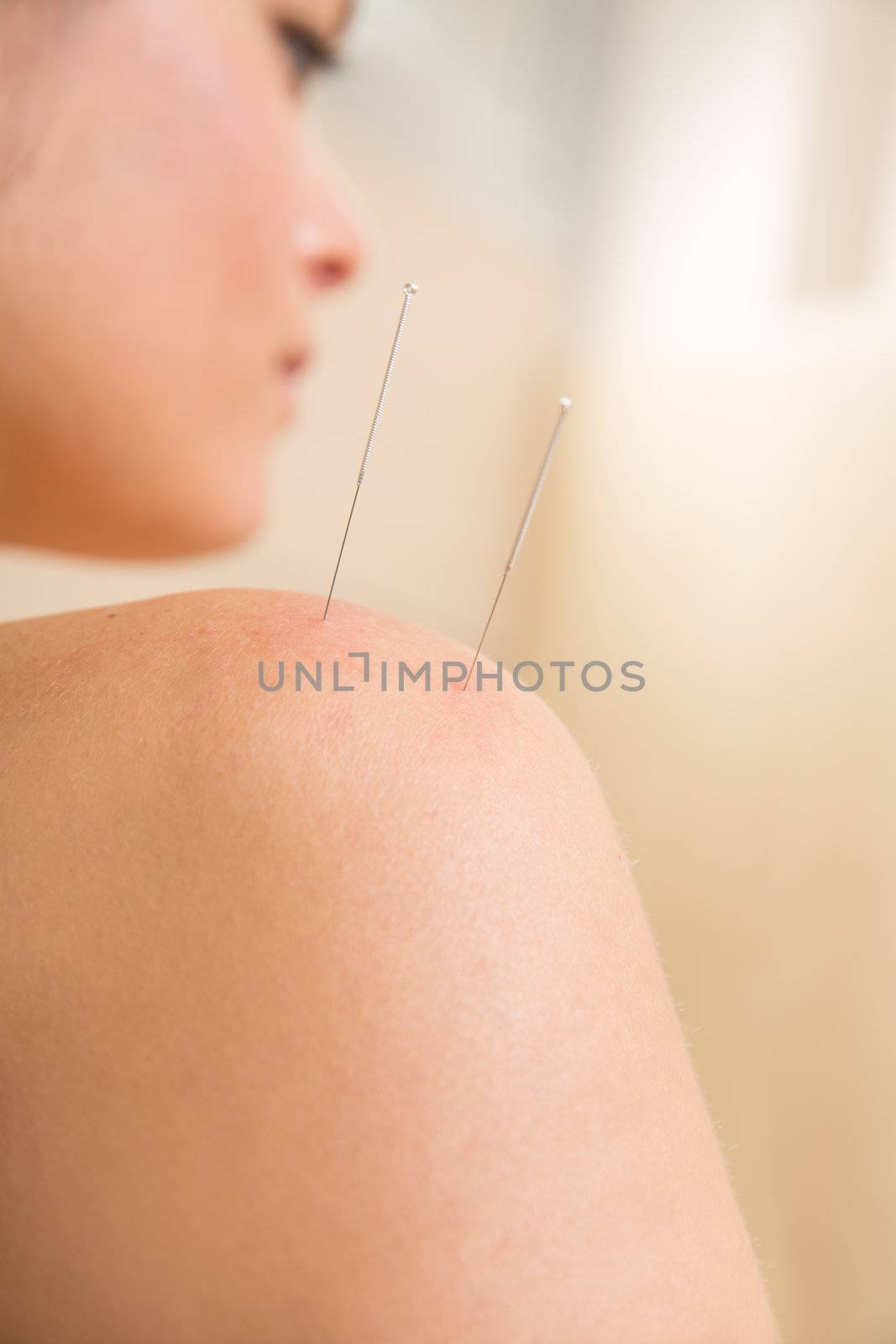 Acupuncture needle pricking on woman shoulder by lunamarina