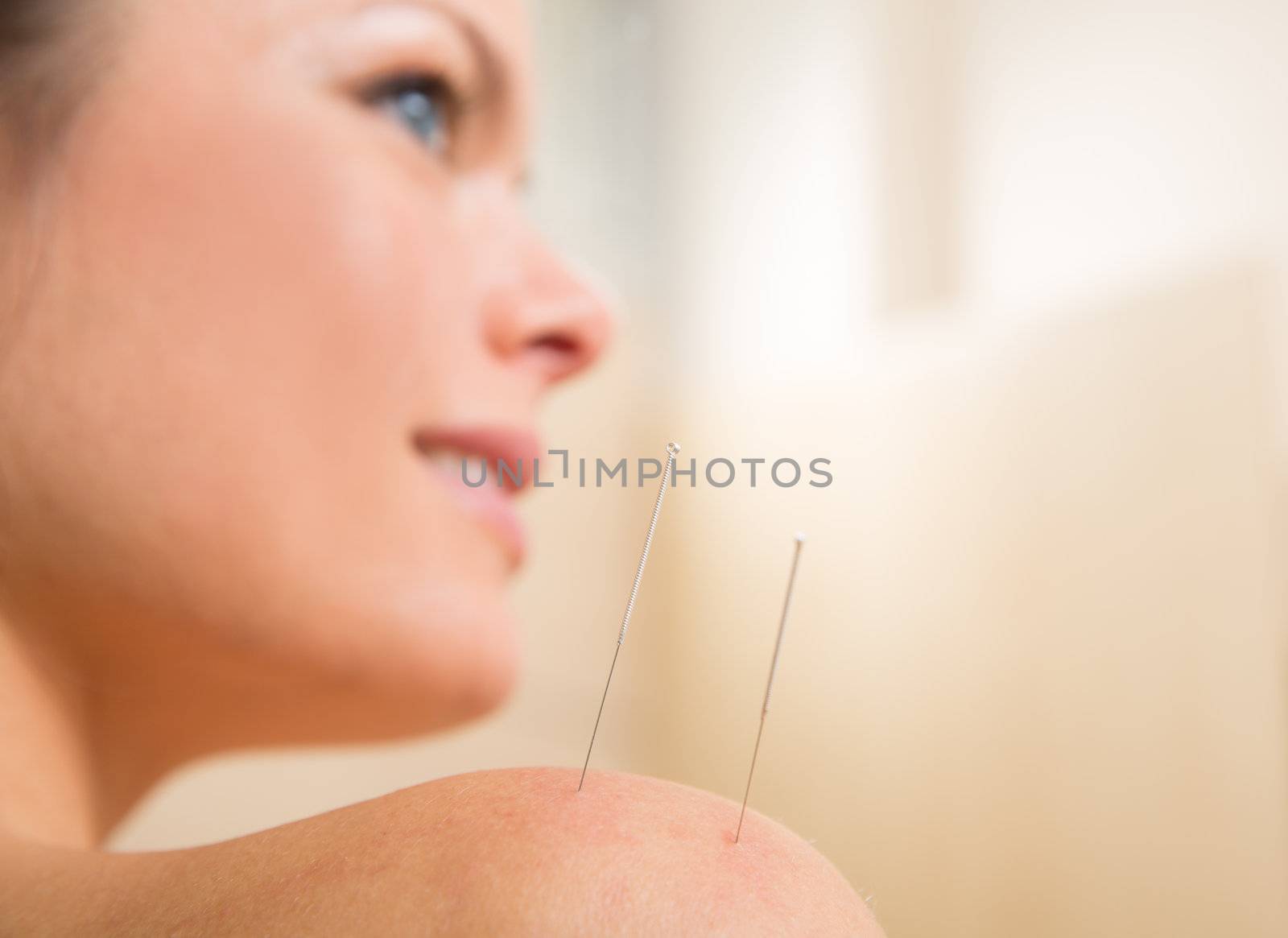 Acupuncture needle pricking on woman shoulder by lunamarina