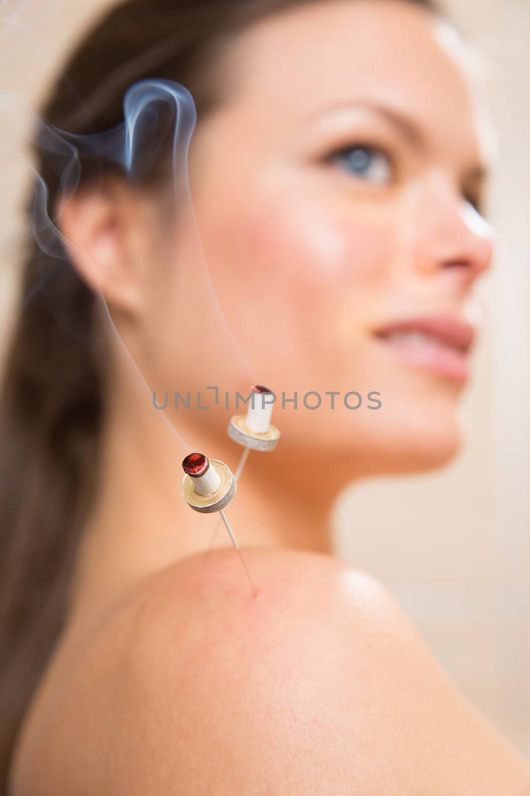 moxibustion acupunture needles heat on woman by lunamarina