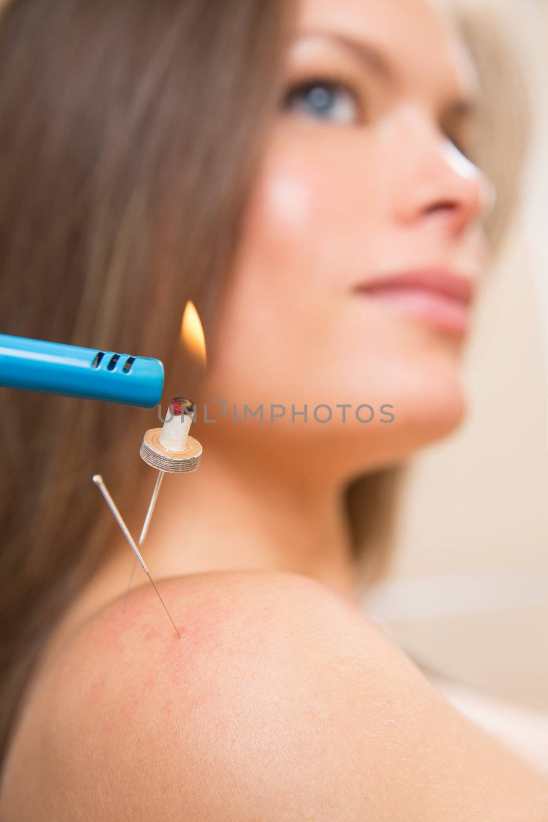 moxibustion acupunture needles heat on woman shoulder closeup