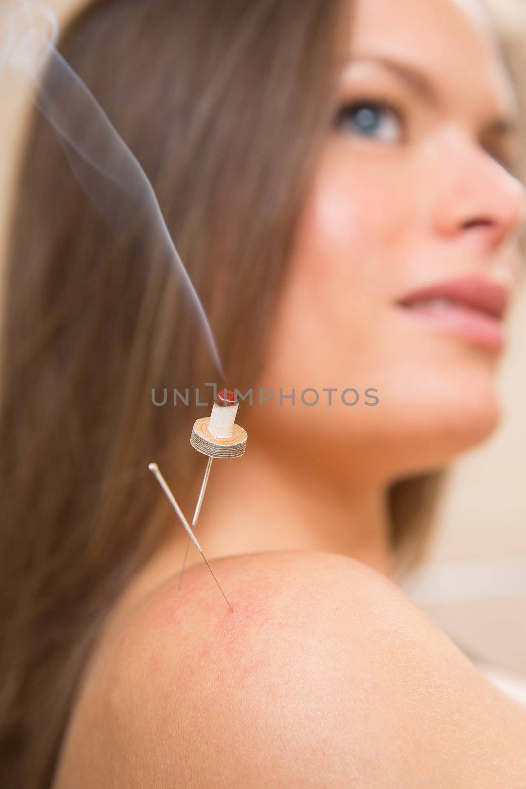 moxibustion acupunture needles heat on woman shoulder closeup