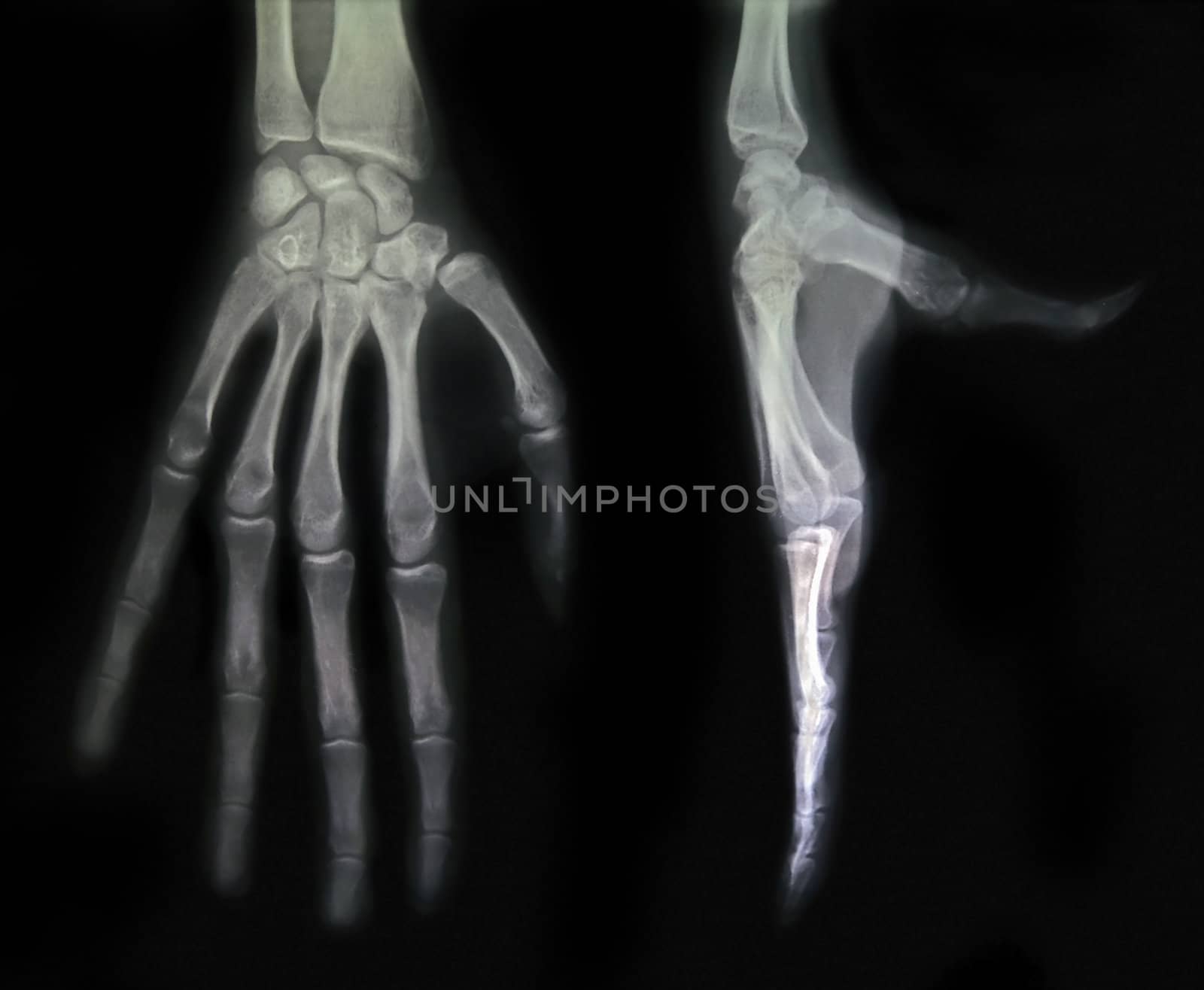 Two views of a hand in an x-ray.