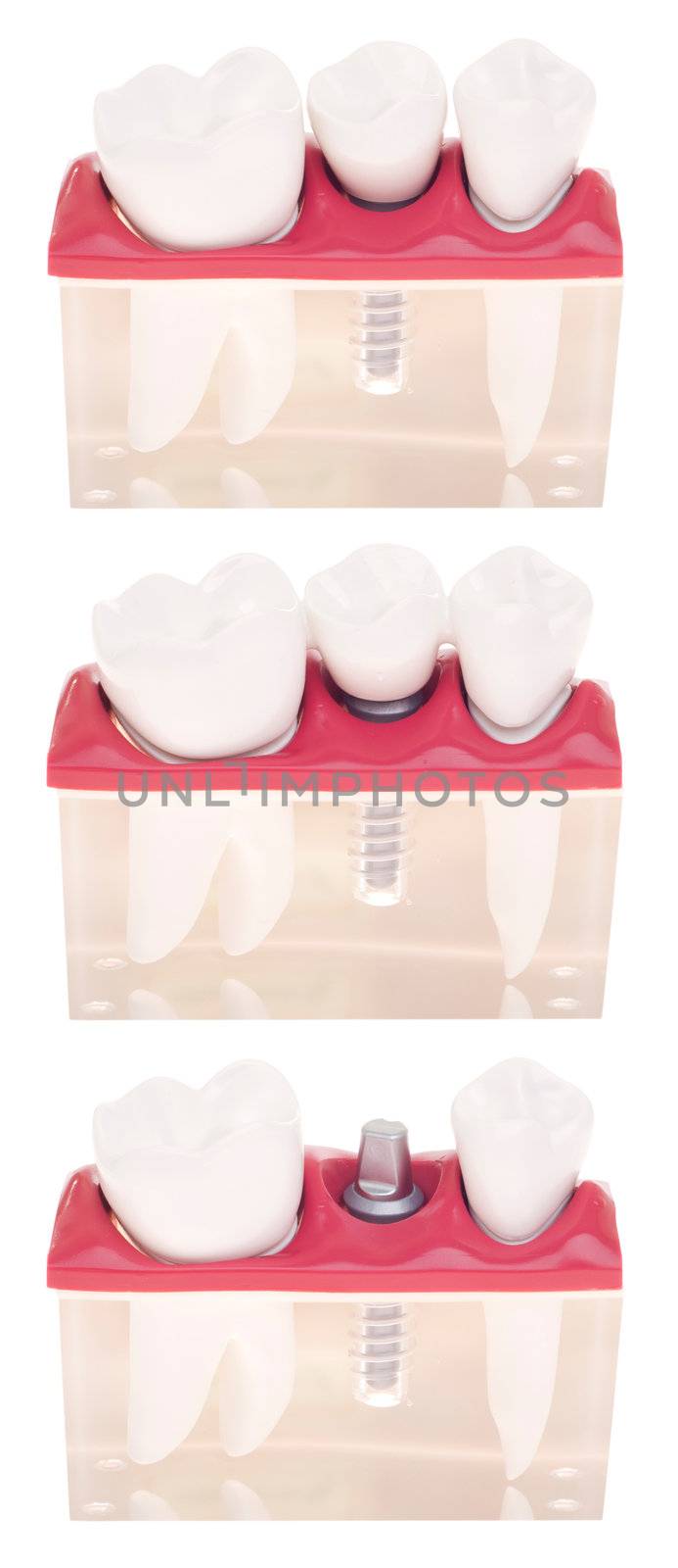 Implant dental model by luissantos84