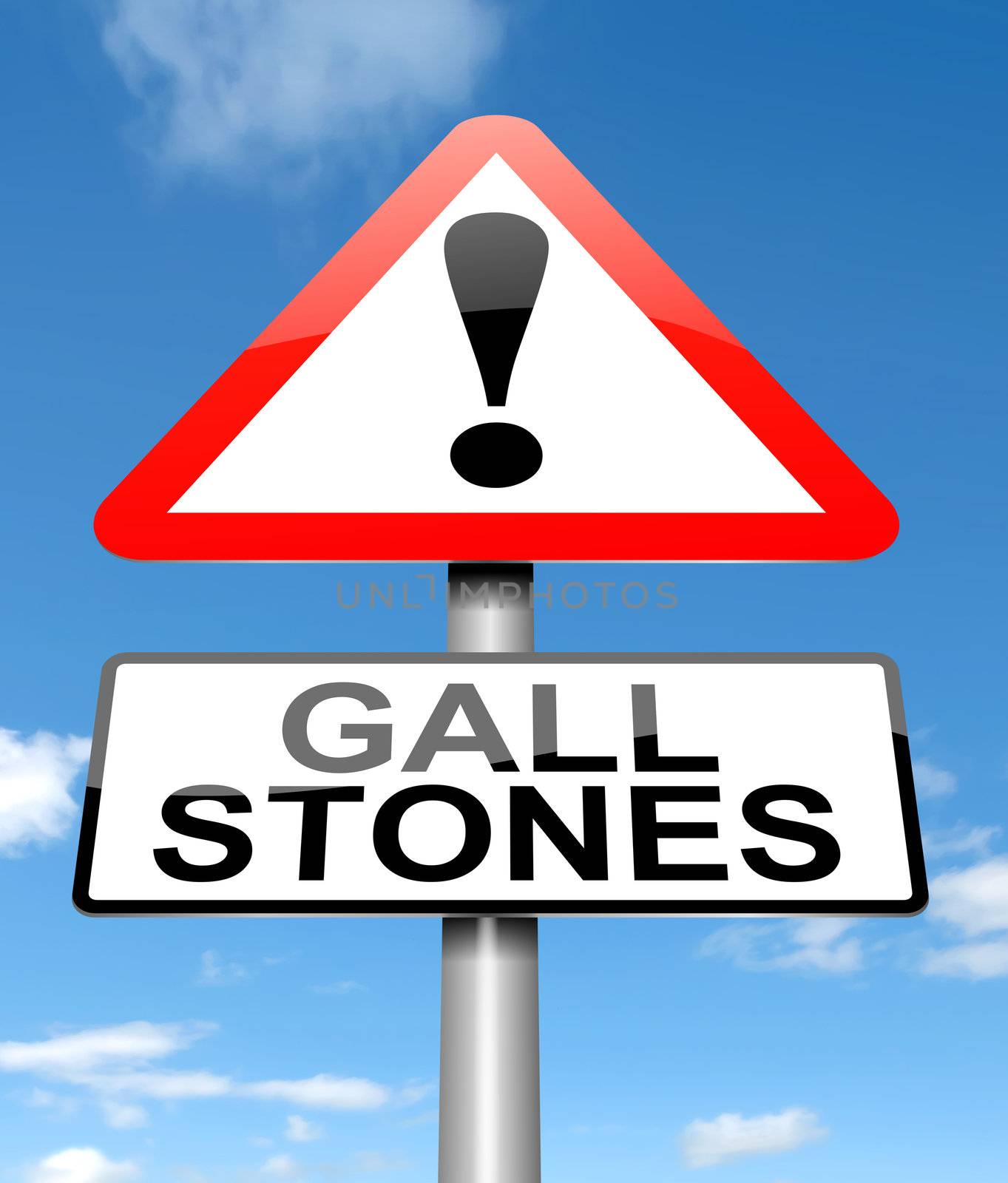 Illustration depicting a sign with a Gall stones concept.