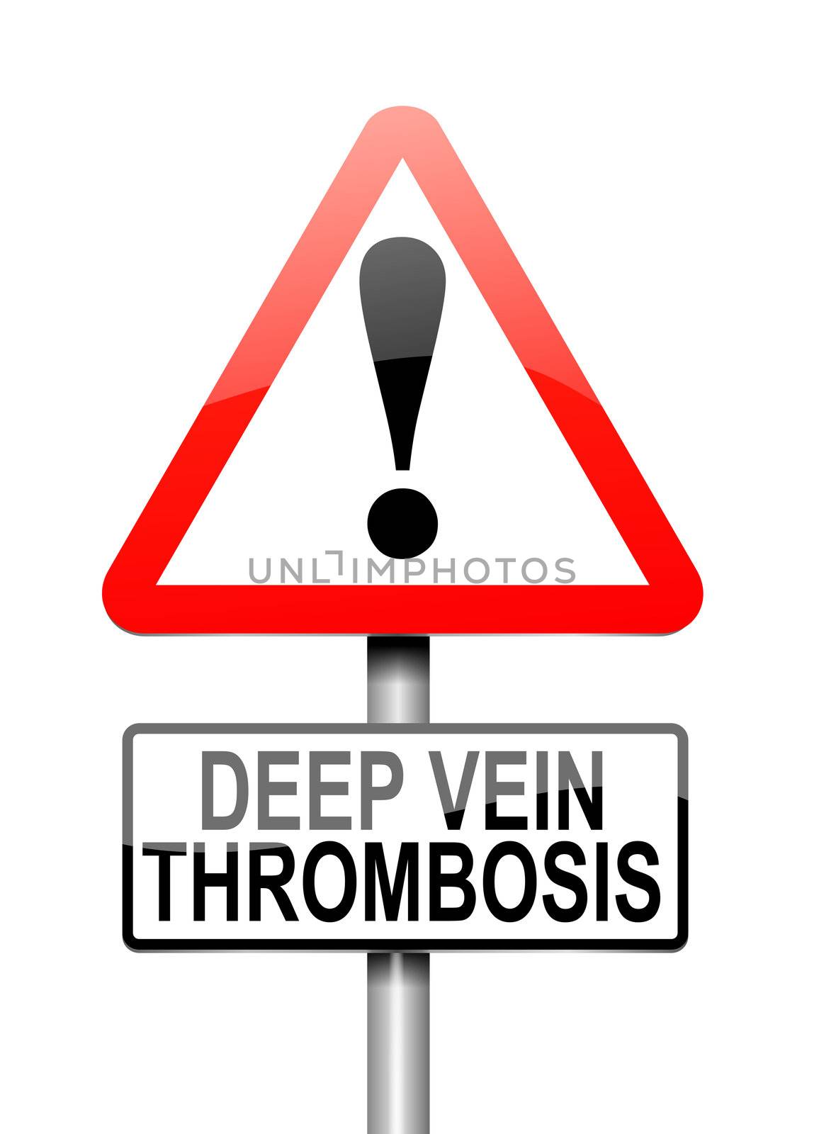 Illustration depicting a sign with a deep vein thrombosis concept.