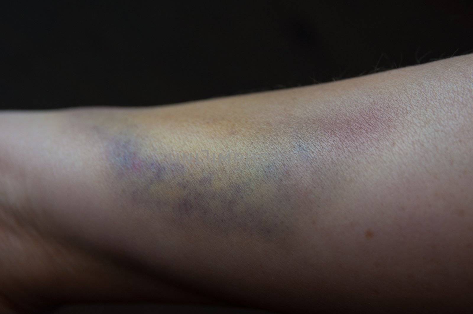 Close-up of a bruised arm of a woman on dark background