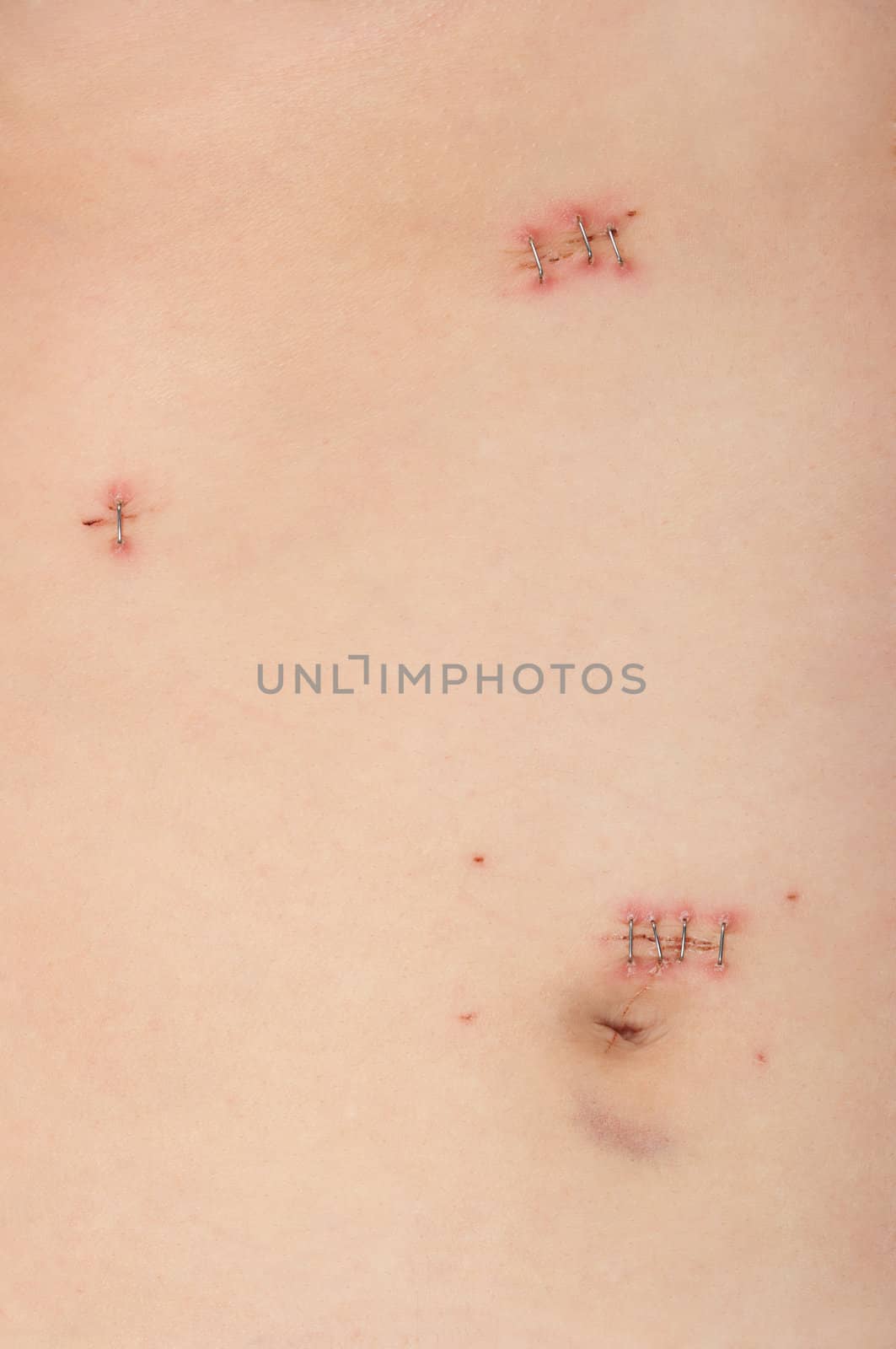 Surgery Incisions by BVDC