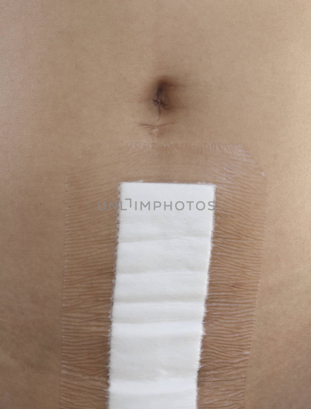 Adhesive bandage care of patients wound after abdominal operate