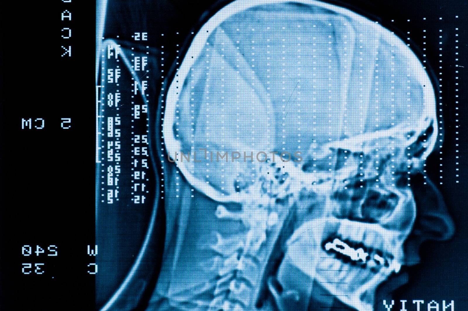 Closeup of a CT scan with brain and skull on it by svedoliver