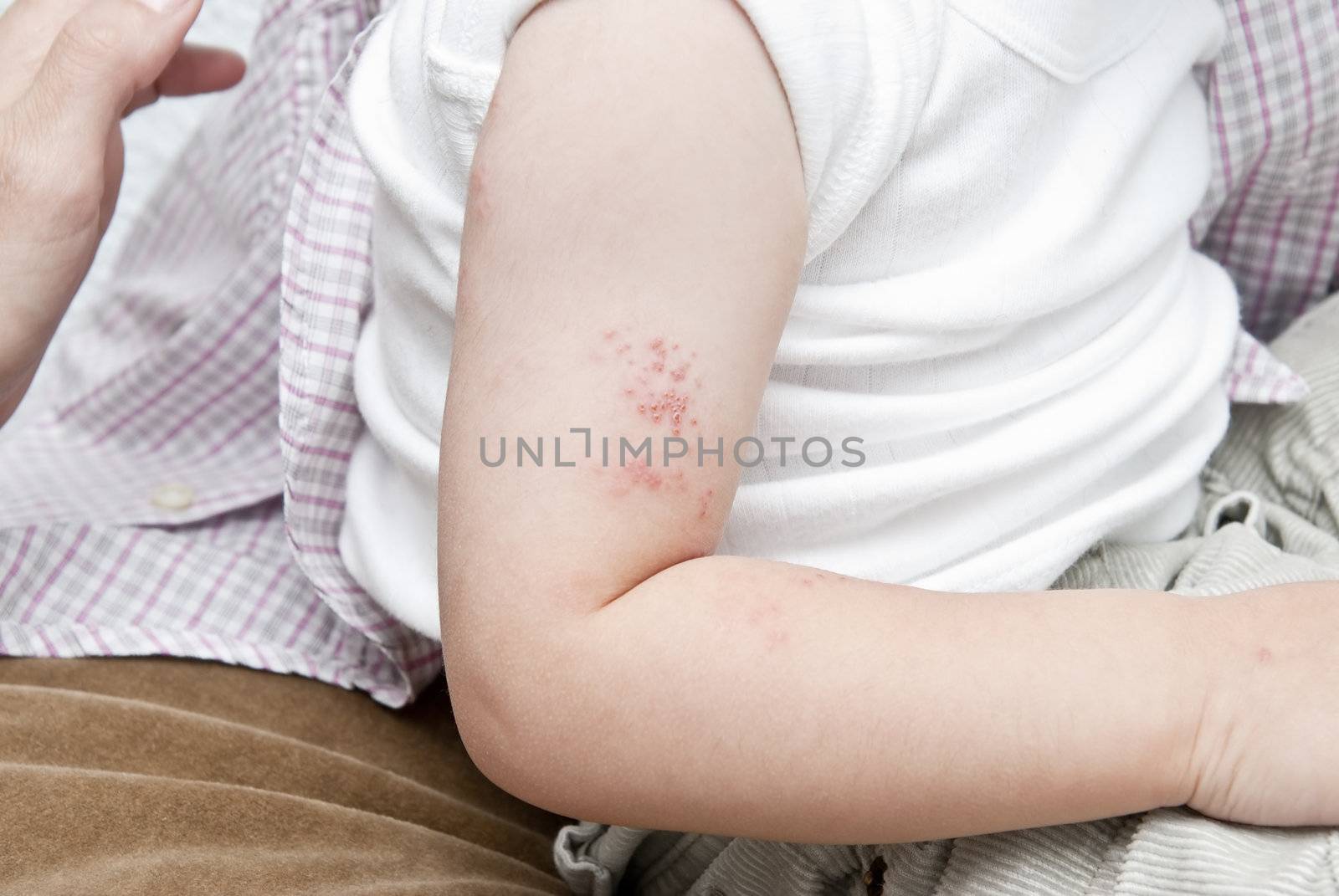 Herpes in a child arm. by angelsimon