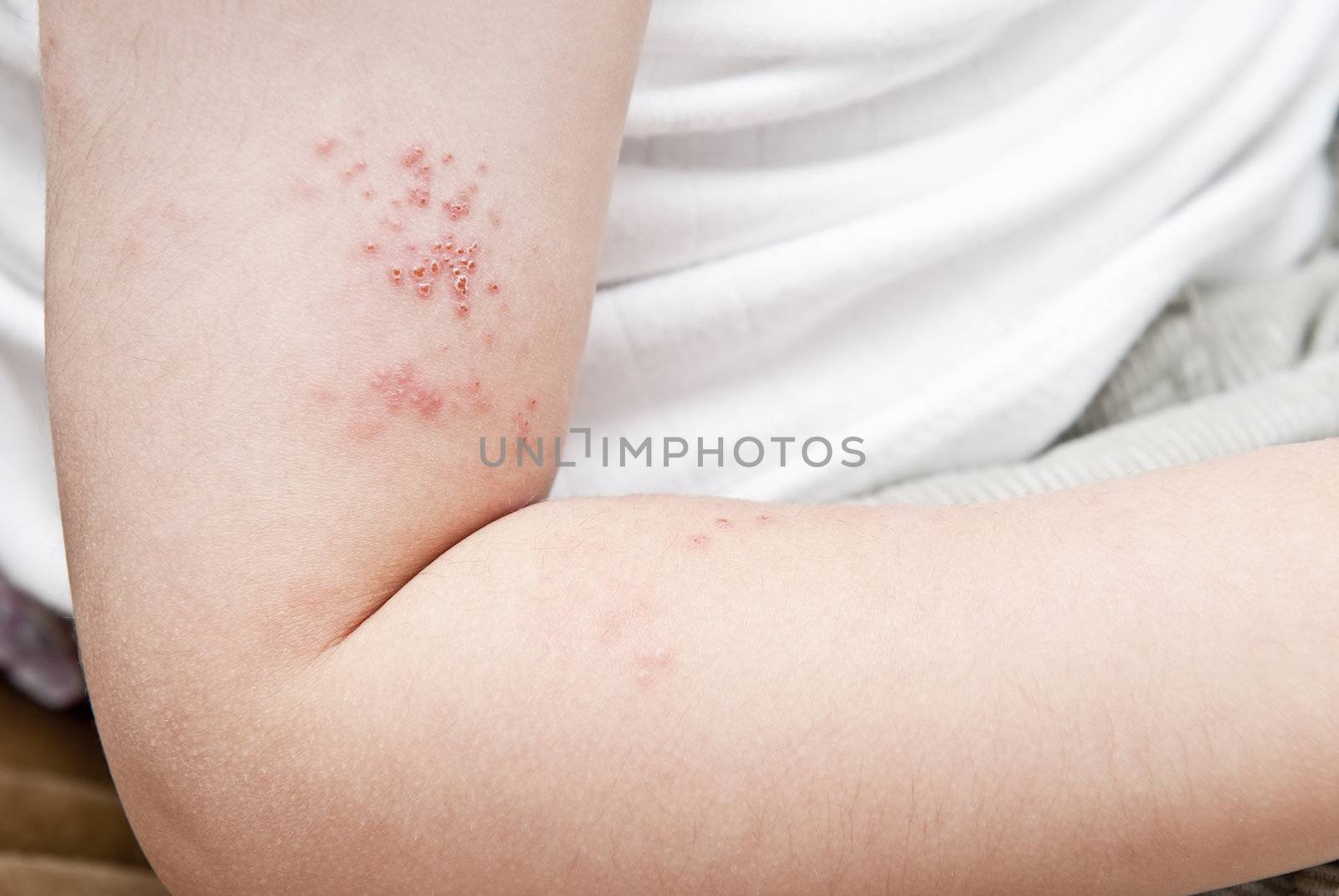 Blisters caused by herpes zoster in the hand and arm of a child.