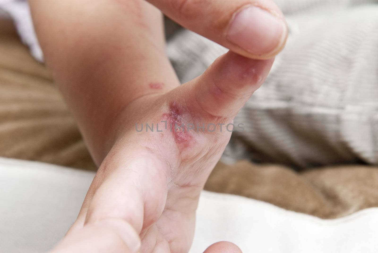 Blisters caused by herpes zoster in the hand and arm of a child.