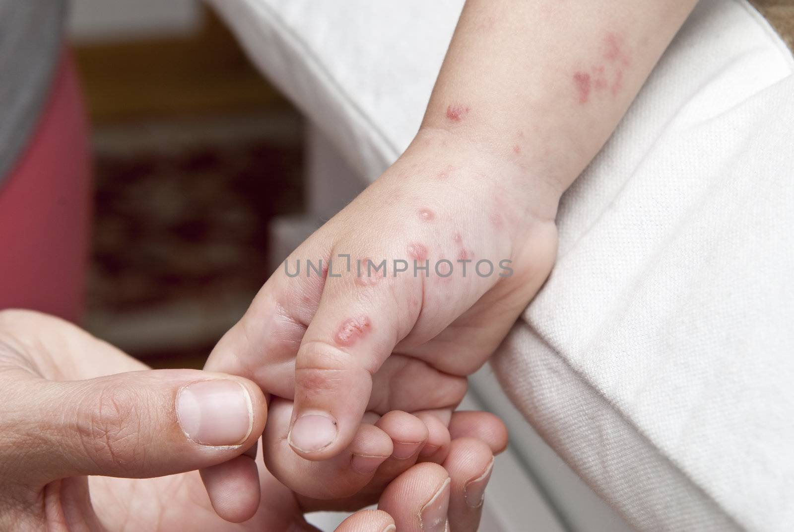 Blisters caused by herpes zoster in the hand and arm of a child.