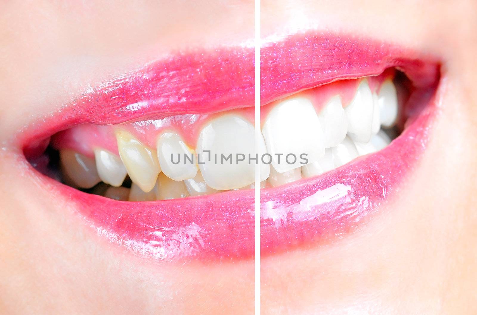 Dental Whitening by ruigsantos