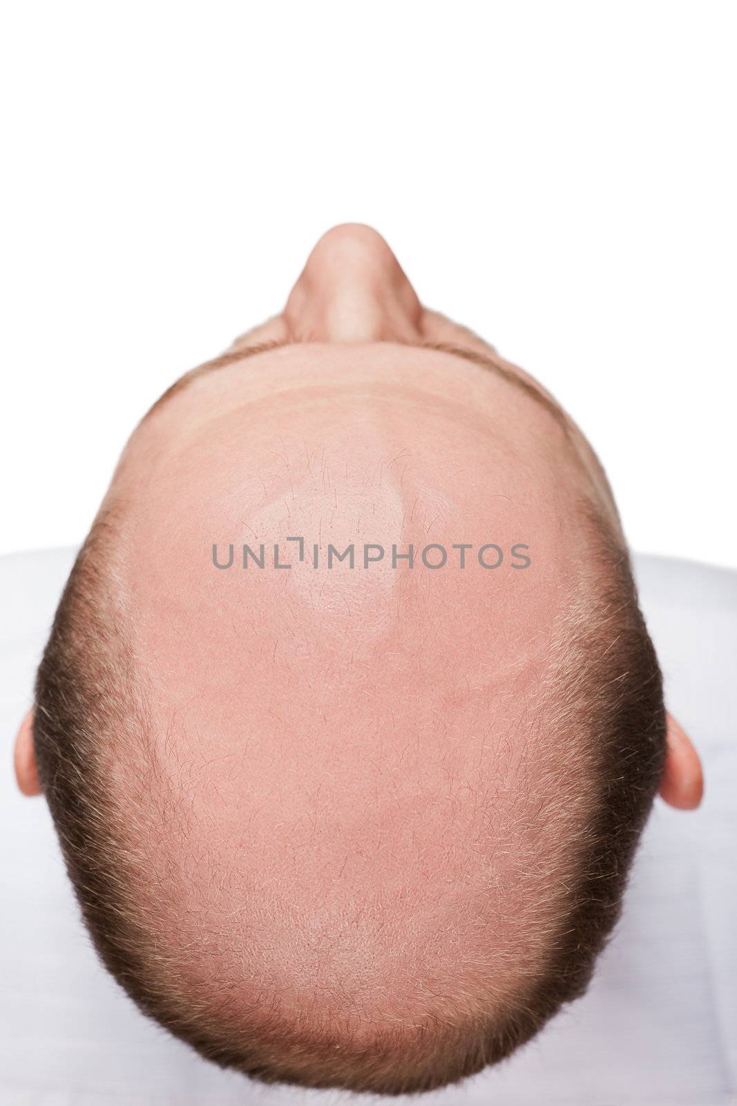 Human alopecia or hair loss - adult man bald head top view