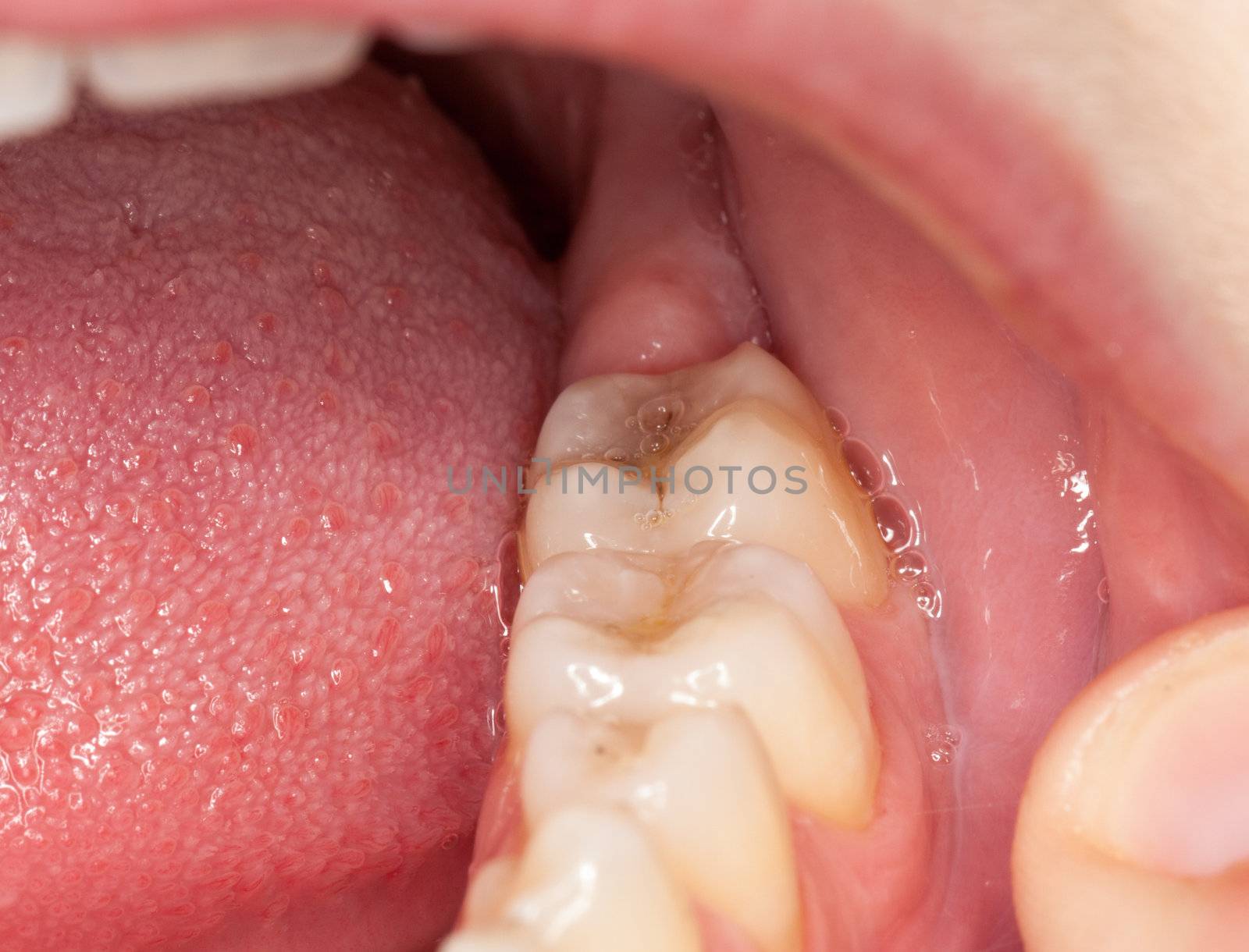 Close up macro shot of interior of mouth and fillings and crowns on teeth