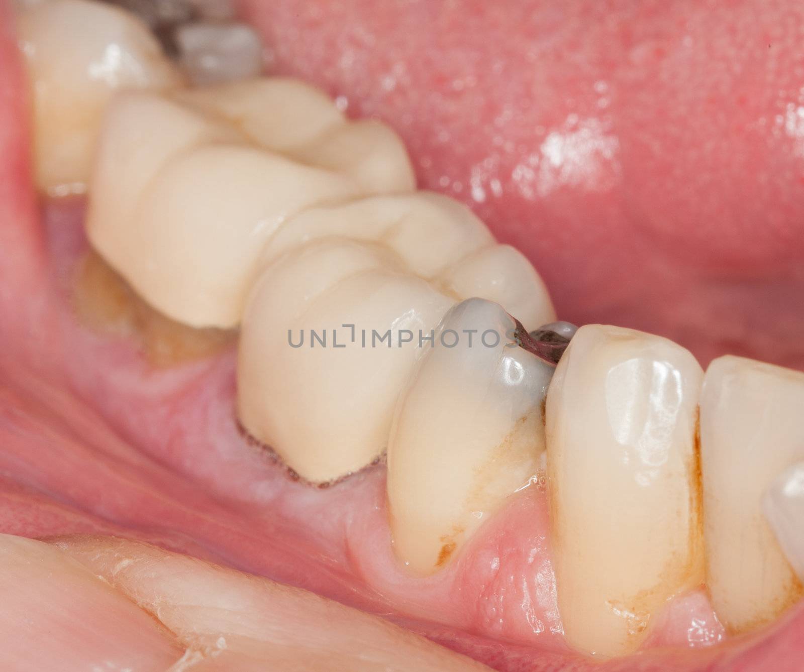 Macro image of filled teeth by steheap