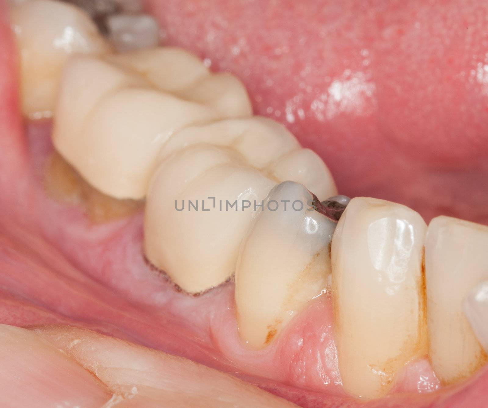 Close up macro shot of interior of mouth and fillings and crowns on teeth