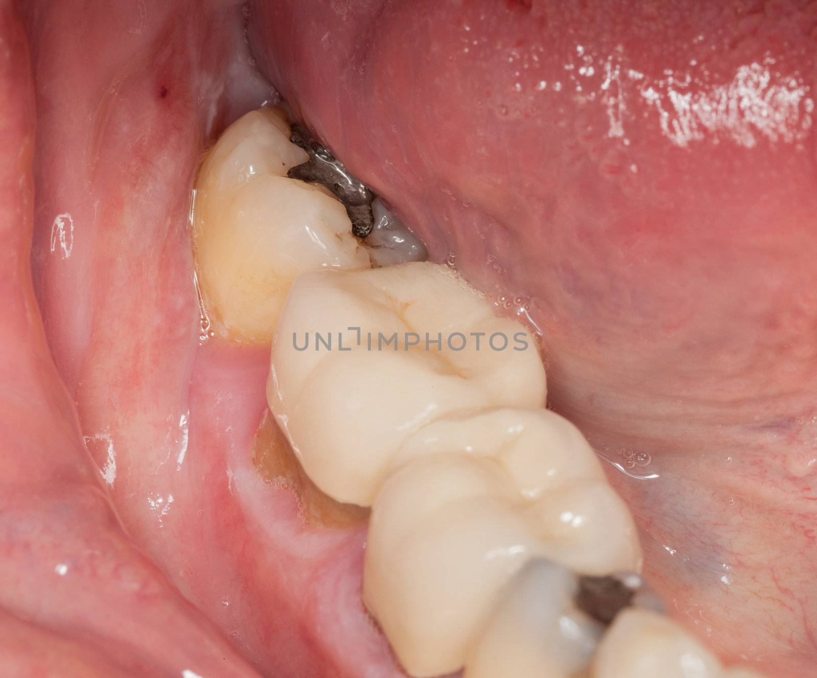 Close up macro shot of interior of mouth and fillings and crowns on teeth