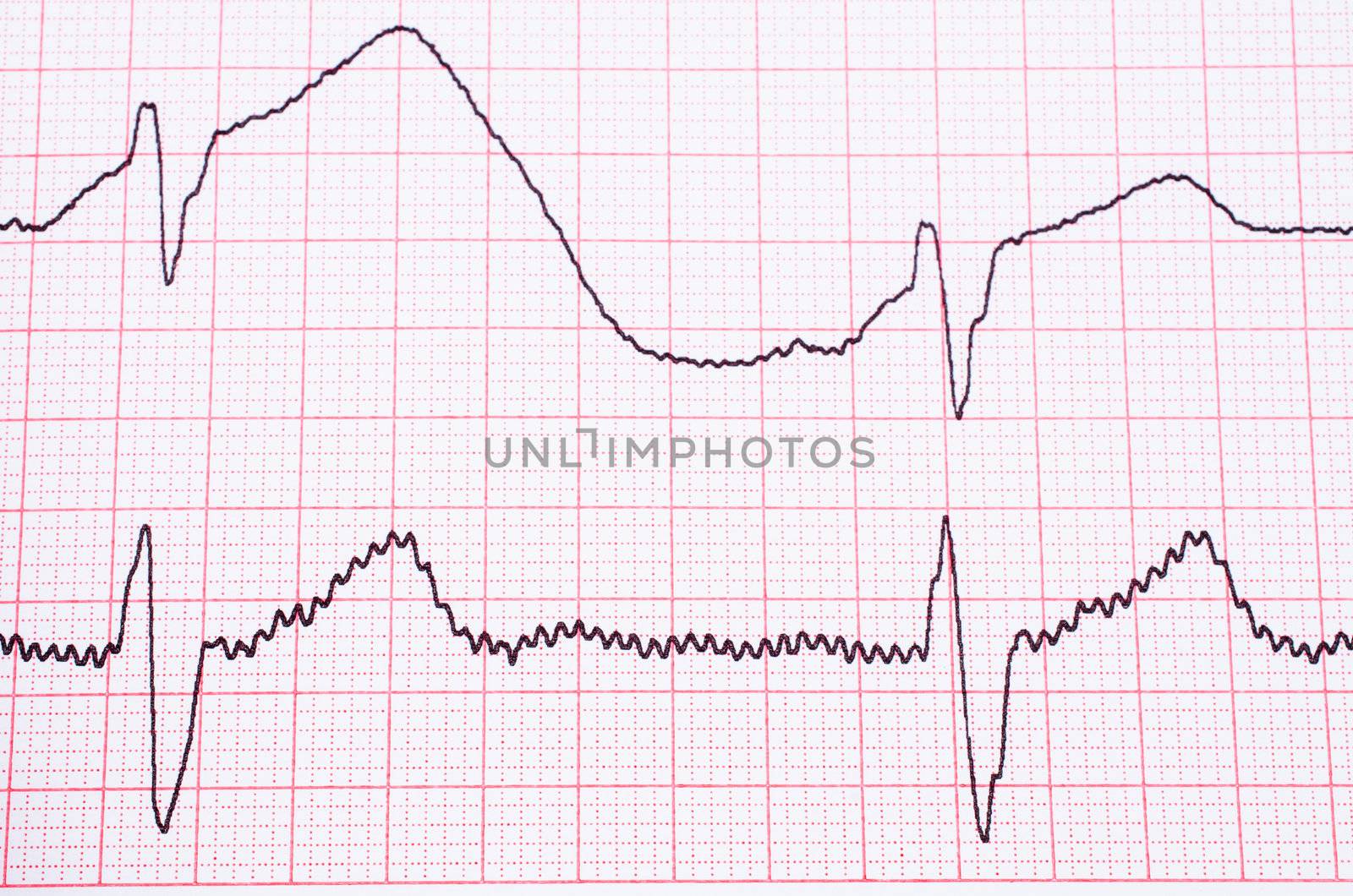 EKG by Nanisimova