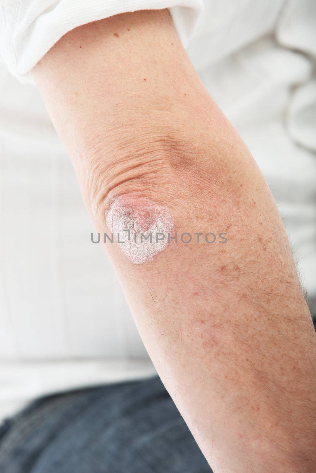 Psoriasis skin or deciding on the elbow - Close-up 