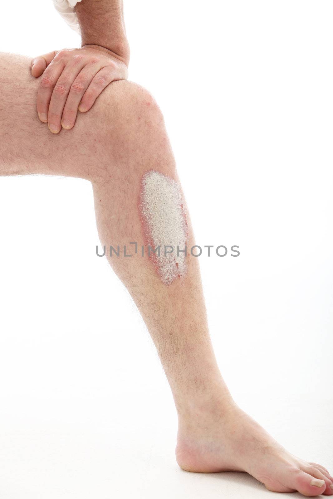 Psoriasis on the leg - close up on white background