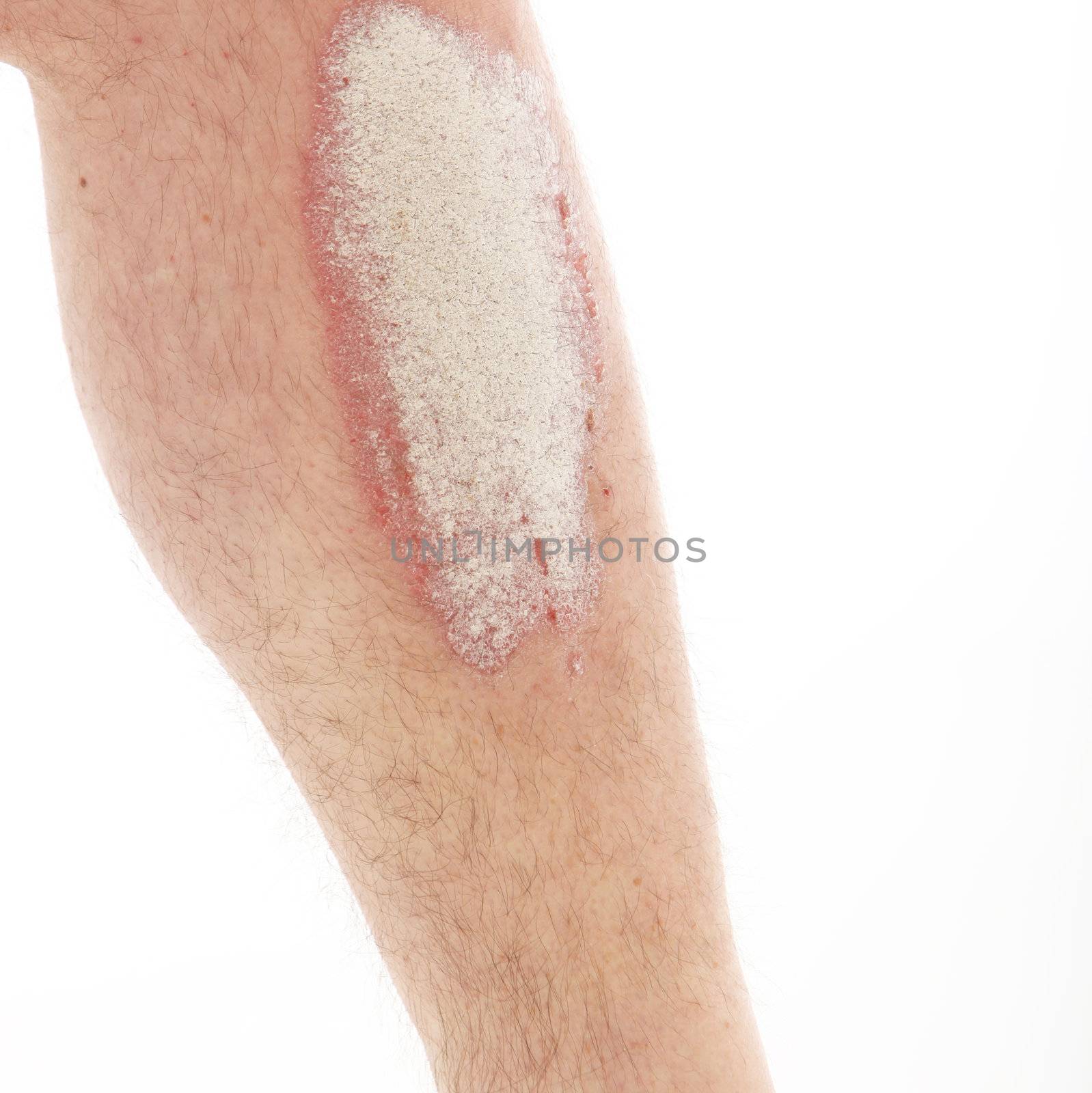 Psoriasis or psoriasis on lower legs - close up by Farina6000