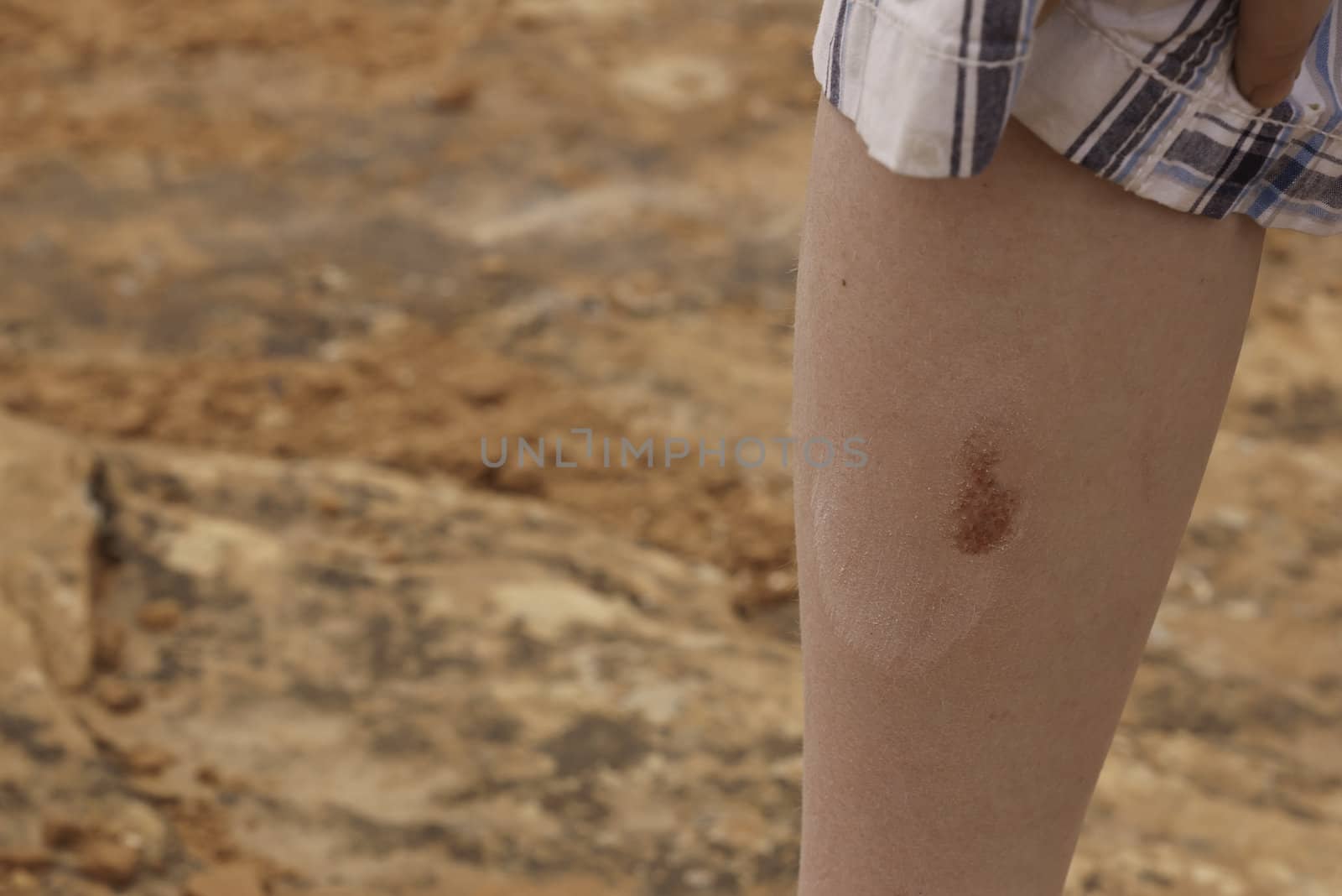 scrape on childs leg from hiking the red rocks in southern Utah