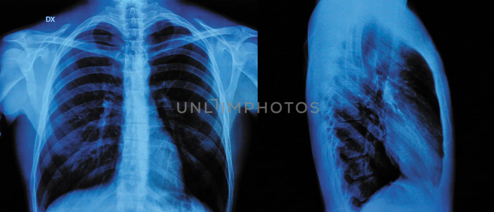 X-Ray Image Of Human Chest front view and lateral view