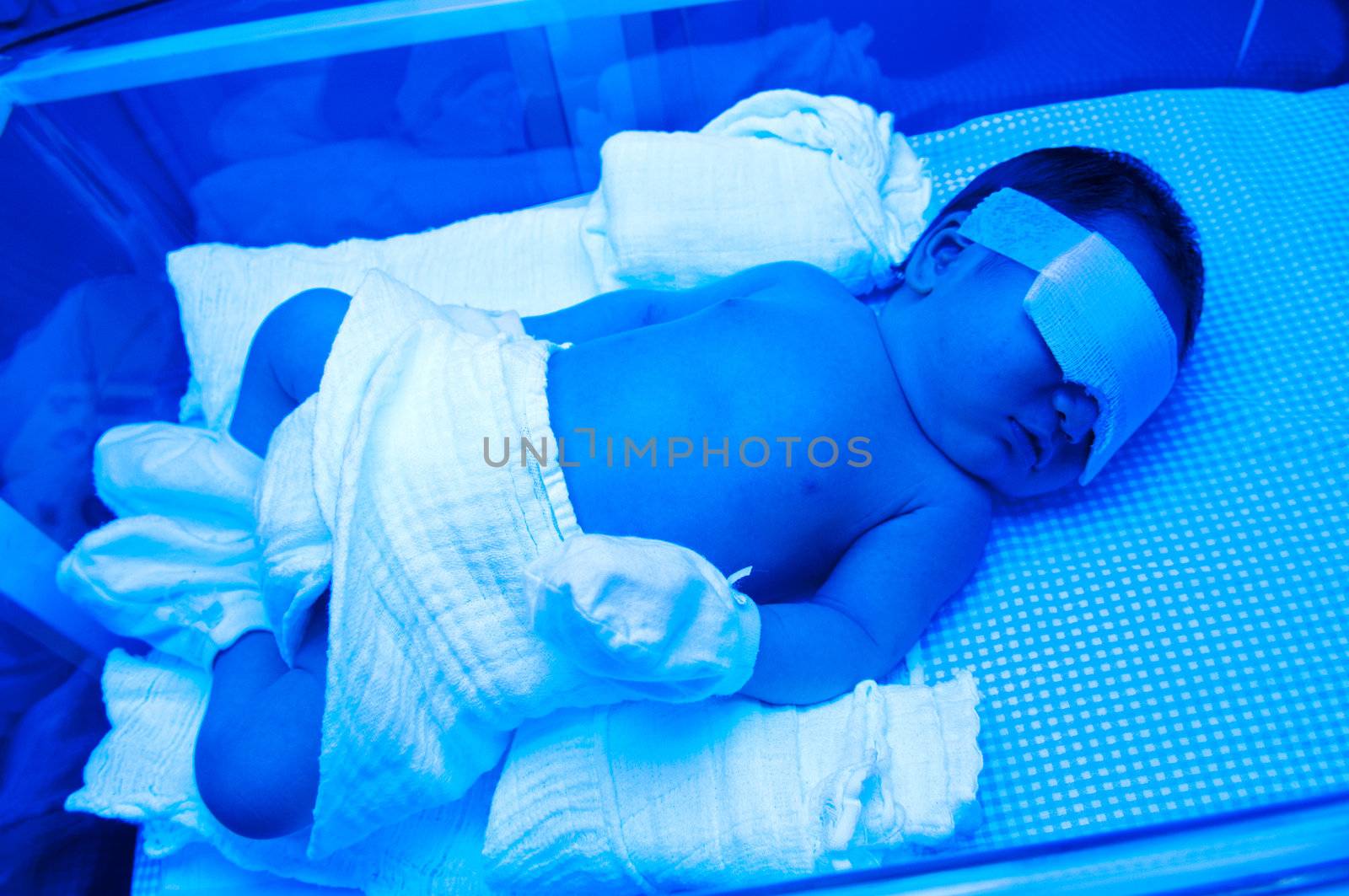 Newborn baby with jaundice under ultraviolet lamp in the incubator.
