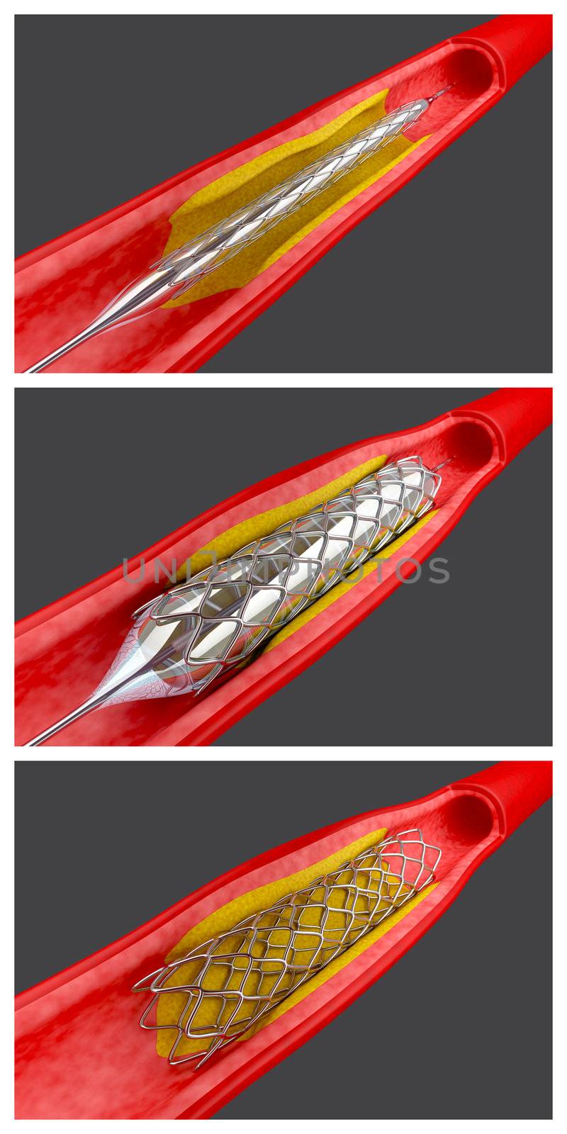 Angioplasty by magraphics