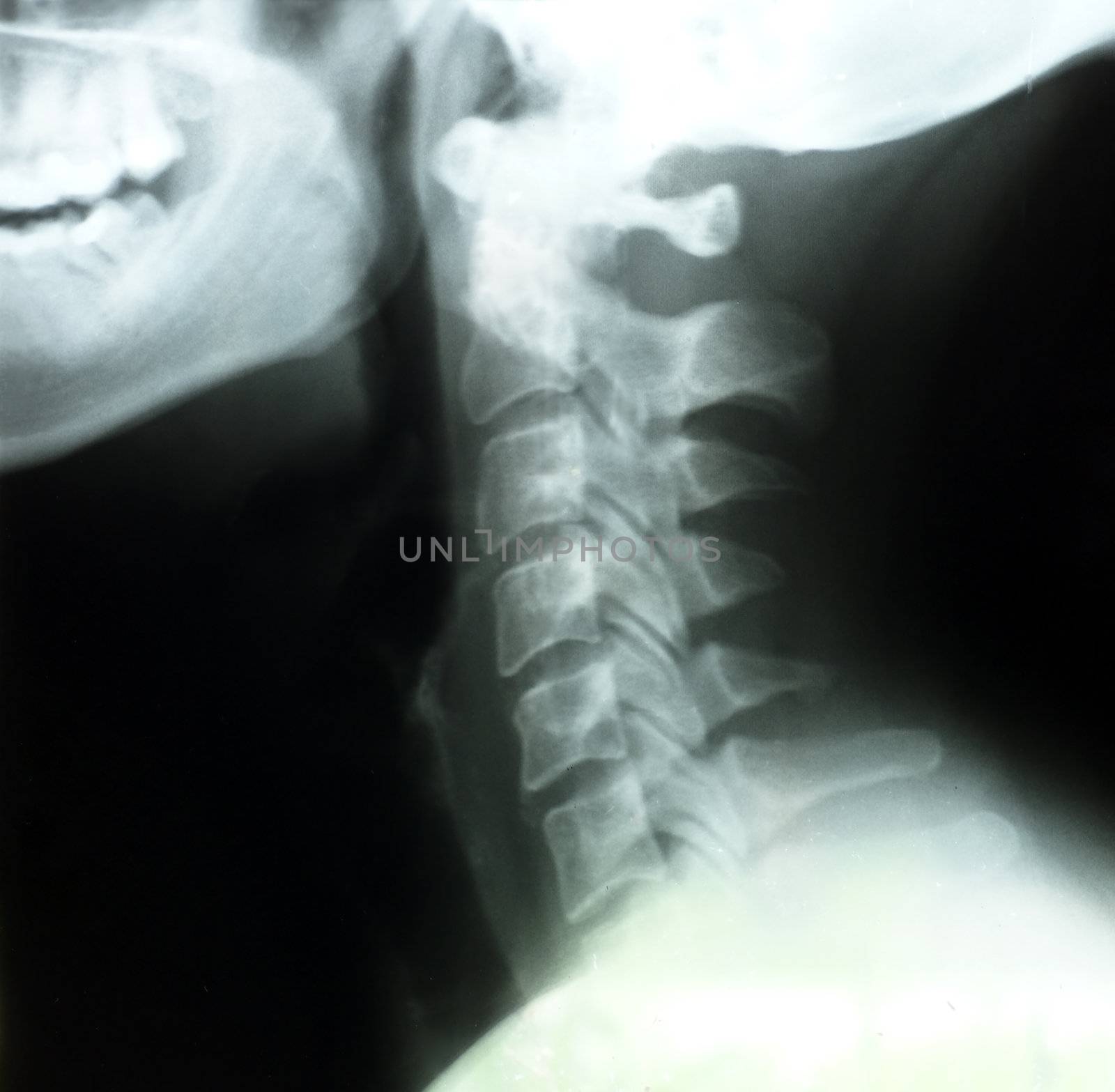X-rays of the neck of a woman patient, showing bones or cervical vertebrae from the side.
