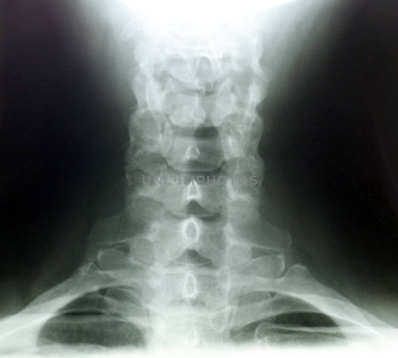 X-rays of back of the neck by Mirage3