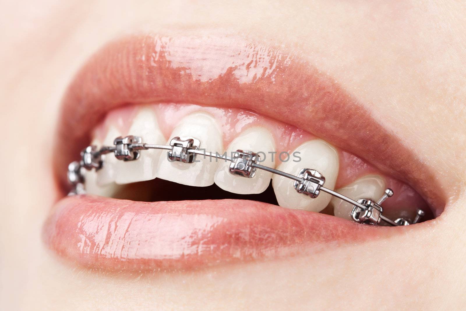 teeth with braces