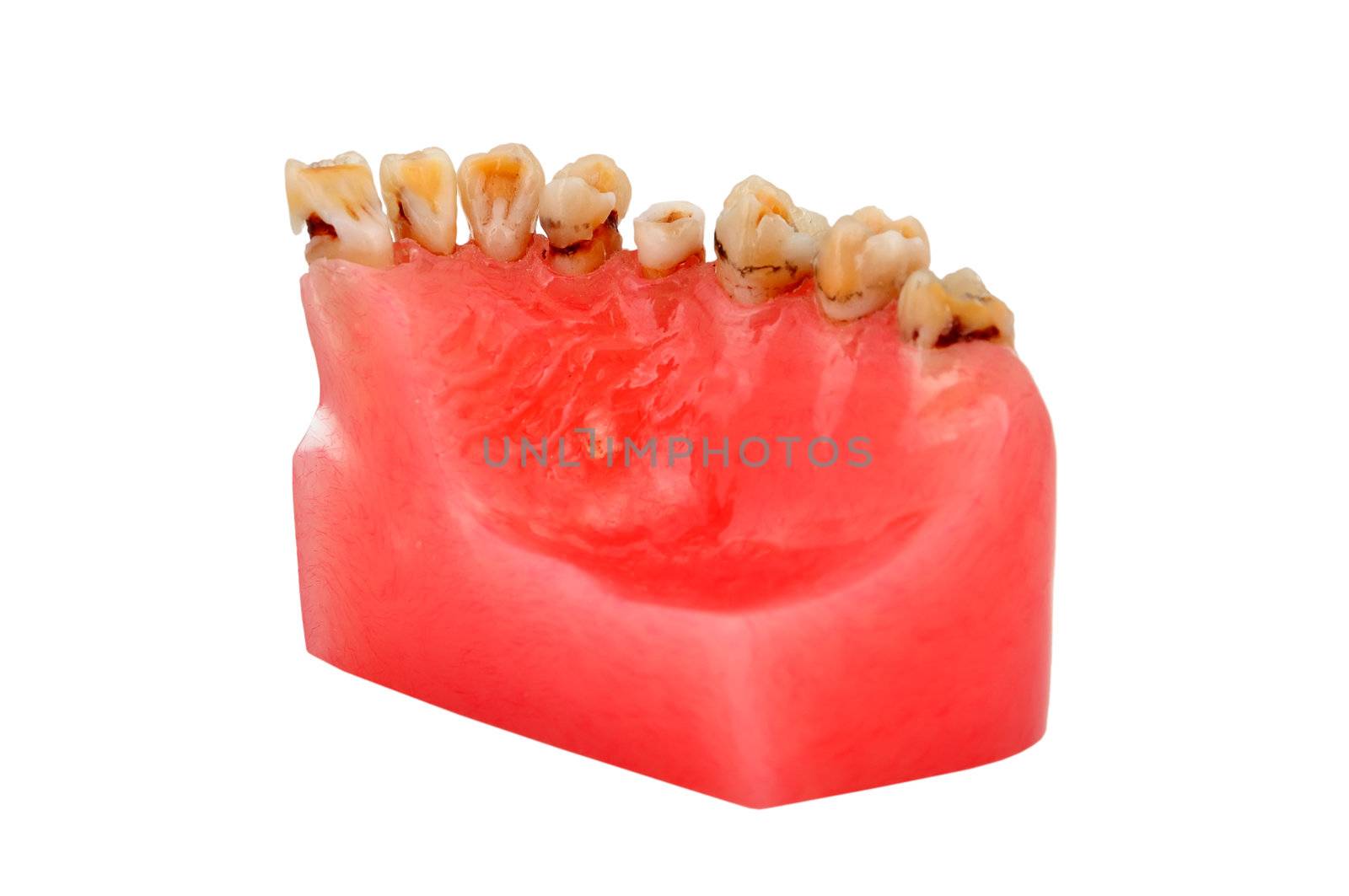 model of human jaw affected tooth decay