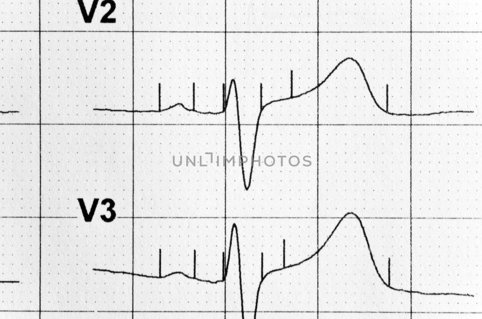 schedule of heart rate drawn by the modern medical device by Serp