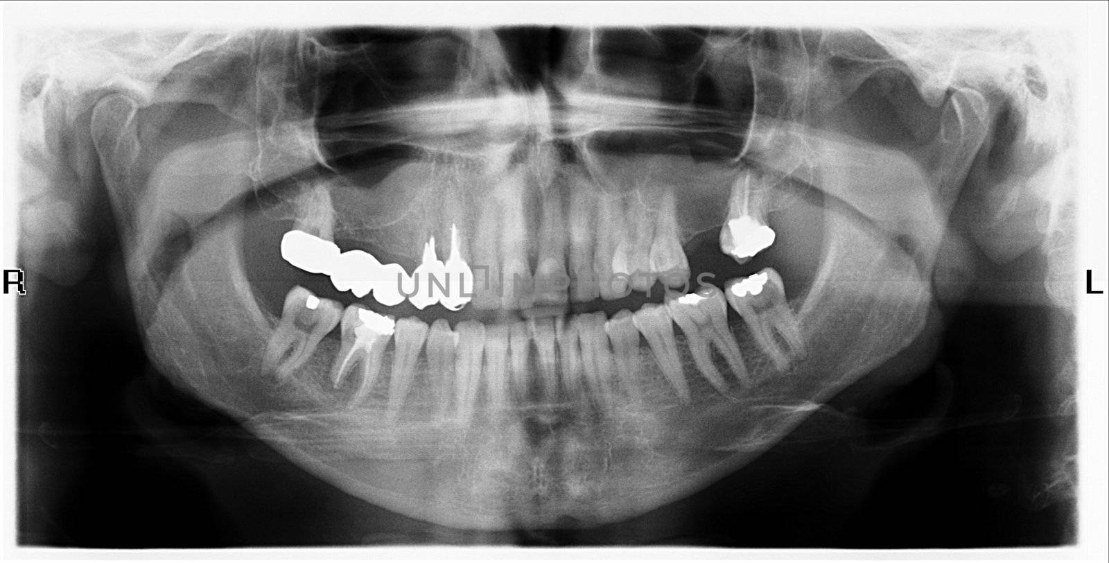 Teeth on X-Ray Image by jamdesign