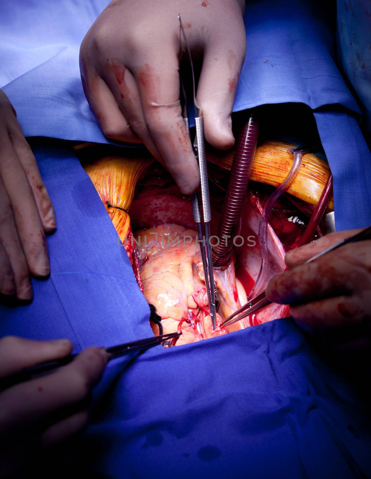 Close-up of heart operation by vilevi