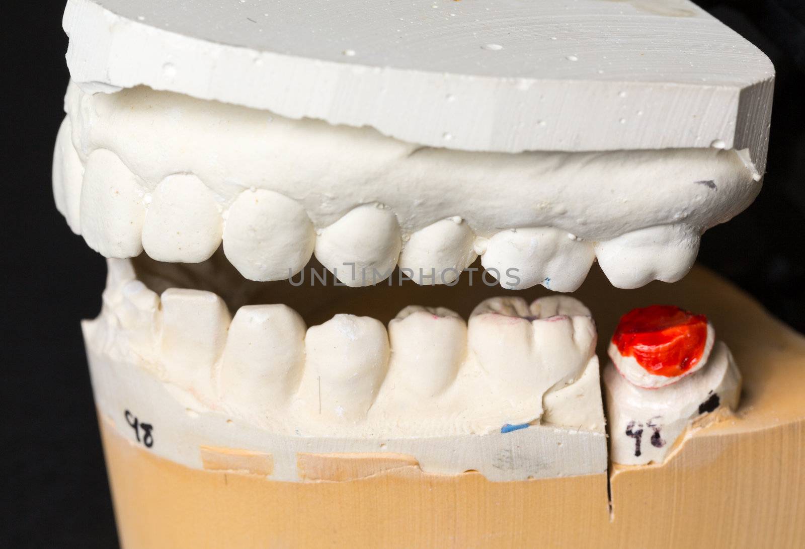 Mould of teeth in plaster taken to prepare brace for orthodontics