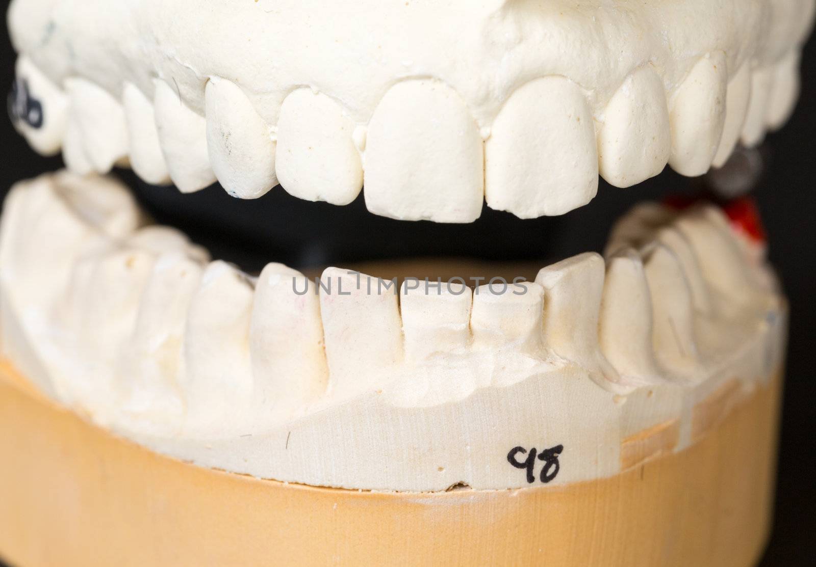 Mould of teeth in plaster taken to prepare brace for orthodontics