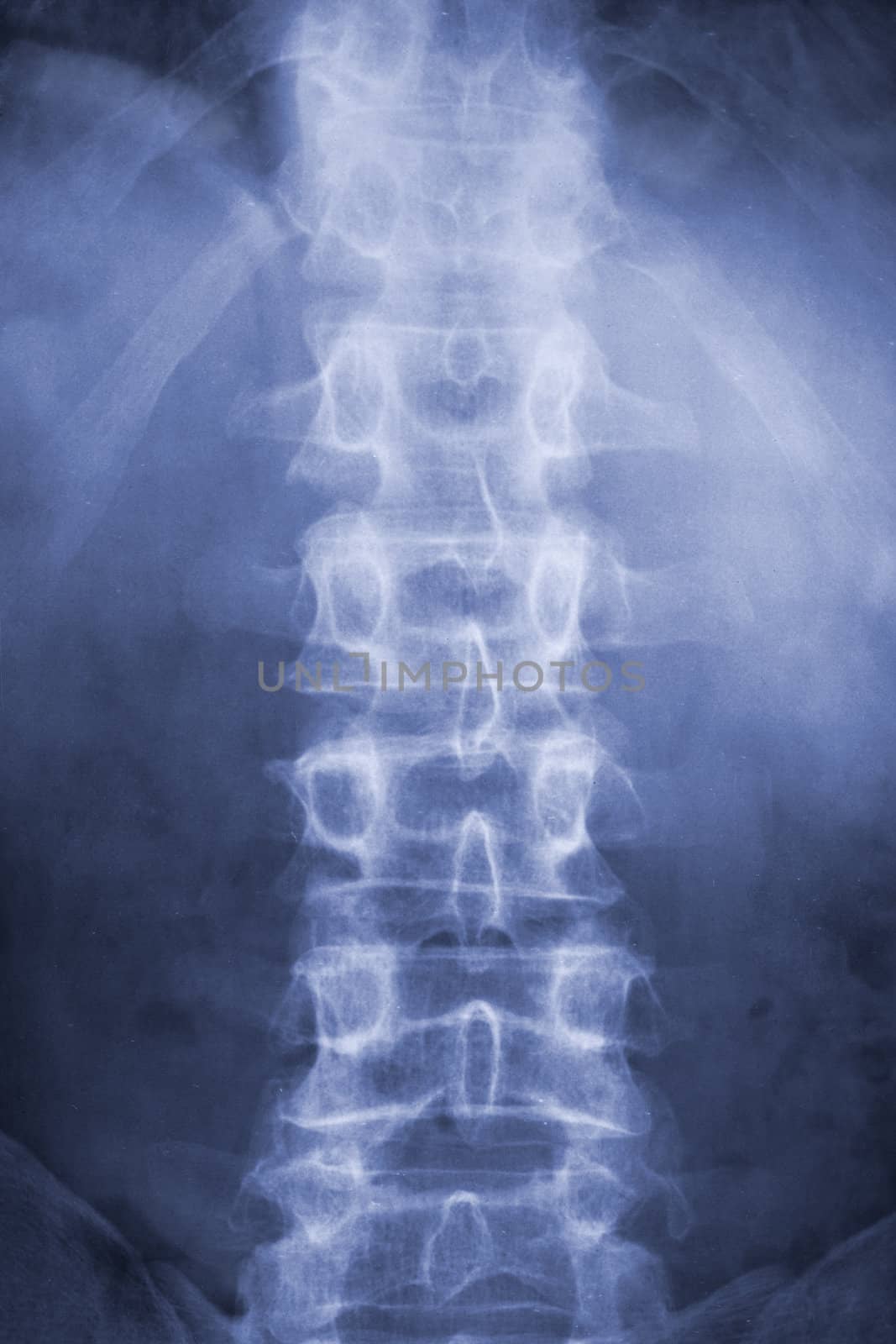 spine and pelvis of a human body on x-ray