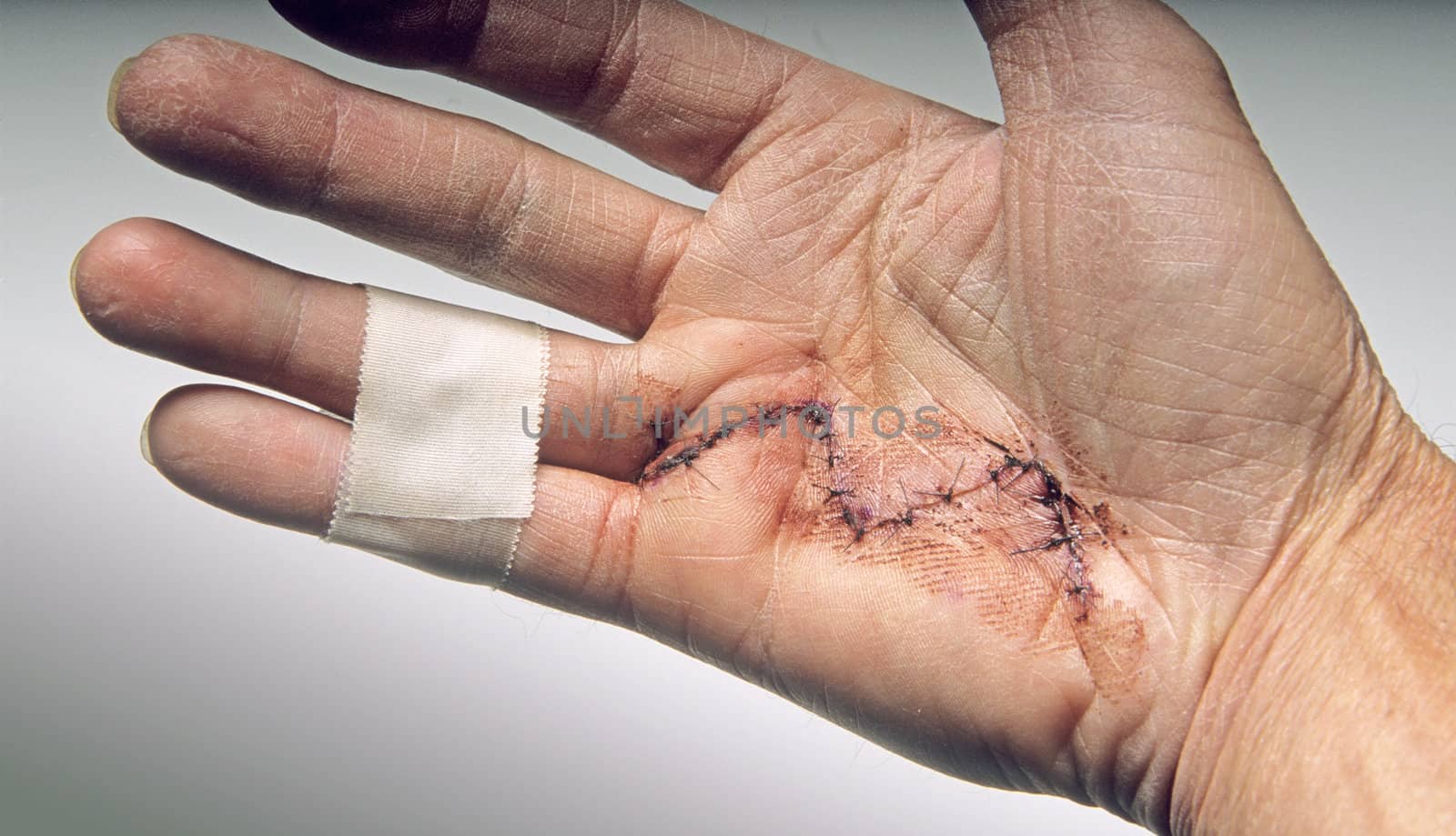 Hand after operation for dupuitrens desease